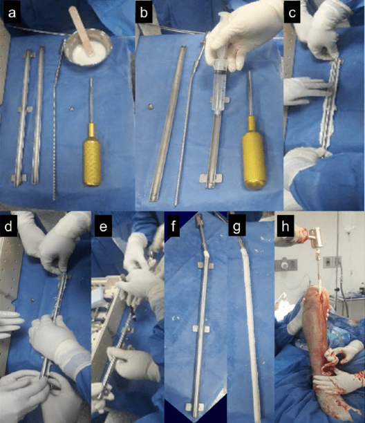 Figura 2. Secuencia intraoperatoria de elaboración del Clavo Medicado CITEC-ULA®: materiales necesarios (a), preparación de la cánula (b), adición del cemento óseo al clavo (c), fraguado del cemento (d), eliminación de excesos (e), clavo con cemento óseo medicado (f y g) y colocación del clavo medicado en el canal medular (h).